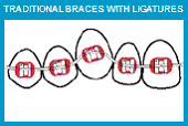 traditional-braces