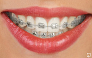 Traditional Metal Braces