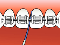 Brushing Step 1