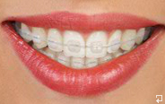 Ceramic Braces