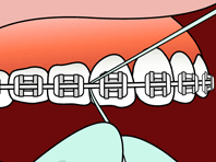 Brushing Step 4